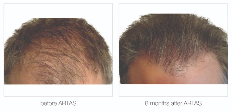 Nashville hair restoration