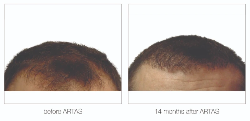 Nashville hair restoration