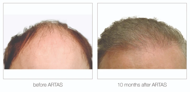 Nashville hair transplant