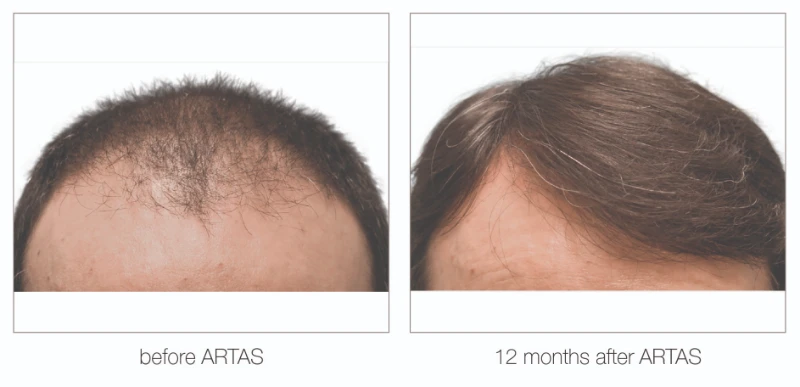 Nashville hair transplant