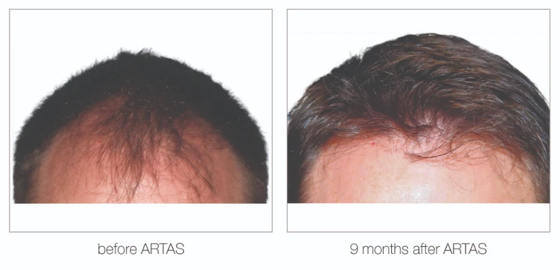 Nashville hair restoration