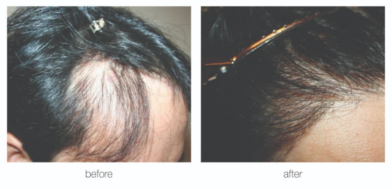 Nashville hair restoration