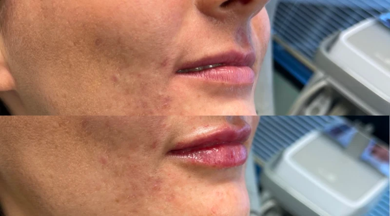 Nashville dermal fillers